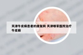天津牛皮癣患者的康复网 天津哪家医院治疗牛皮癣