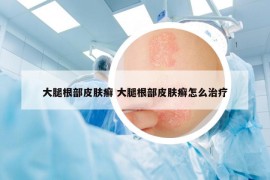 大腿根部皮肤癣 大腿根部皮肤癣怎么治疗