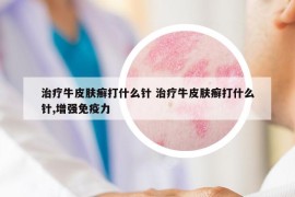治疗牛皮肤癣打什么针 治疗牛皮肤癣打什么针,增强免疫力