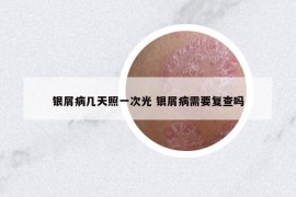 银屑病几天照一次光 银屑病需要复查吗
