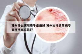 苏州什么医院看牛皮癣好 苏州治疗银屑病专业医院哪家最好