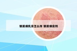 银屑病乳膏怎么样 银屑病膏剂