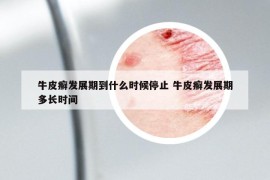 牛皮癣发展期到什么时候停止 牛皮癣发展期多长时间