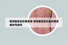 链球菌感染性银屑病 链球菌感染引起的银屑病会传染吗