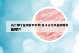 浙江哪个医院看银屑病 浙江治疗银屑病哪家医院好?