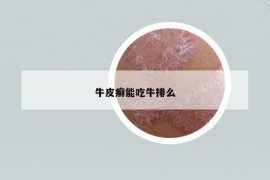 牛皮癣能吃牛排么