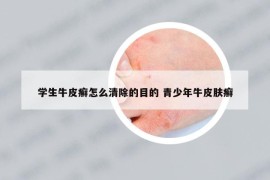 学生牛皮癣怎么清除的目的 青少年牛皮肤癣