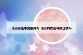 淮山会是牛皮癣痒吗 淮山的皮会导致过敏吗