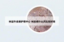 树运牛皮癣护理中心 树皮癣什么药比较好用
