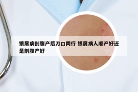银屑病剖腹产后刀口同行 银屑病人顺产好还是剖腹产好