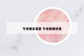 牛皮癣去澡堂 牛皮肤癣洗澡