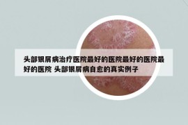 头部银屑病治疗医院最好的医院最好的医院最好的医院 头部银屑病自愈的真实例子