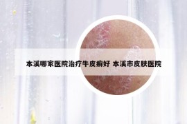 本溪哪家医院治疗牛皮癣好 本溪市皮肤医院