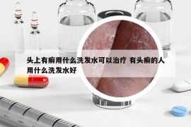 头上有癣用什么洗发水可以治疗 有头癣的人用什么洗发水好