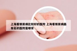 上海看银屑病比较好的医院 上海看银屑病最有名的医院是哪家