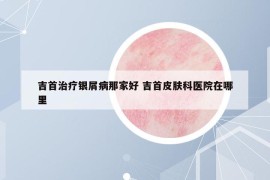 吉首治疗银屑病那家好 吉首皮肤科医院在哪里