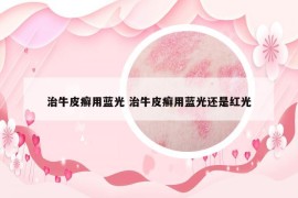 治牛皮癣用蓝光 治牛皮癣用蓝光还是红光
