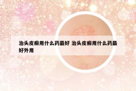 治头皮癣用什么药最好 治头皮癣用什么药最好外用