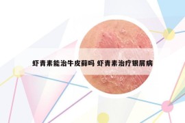 虾青素能治牛皮藓吗 虾青素治疗银屑病