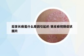 后背长癣是什么原因引起的 银皮癣初期症状图片