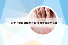 头发上有银屑病怎么办 头发长银屑怎么办