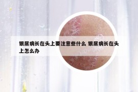 银屑病长在头上要注意些什么 银屑病长在头上怎么办