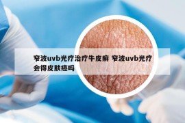 窄波uvb光疗治疗牛皮癣 窄波uvb光疗会得皮肤癌吗