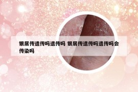 银屑传遗传吗遗传吗 银屑传遗传吗遗传吗会传染吗