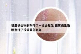 银屑病生物制剂停了一定会复发 银屑病生物制剂打了没效果怎么办