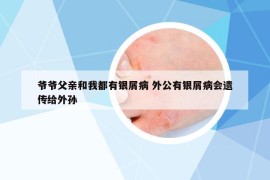爷爷父亲和我都有银屑病 外公有银屑病会遗传给外孙