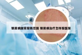 银屑病国家报销范围 银屑病治疗怎样报医保