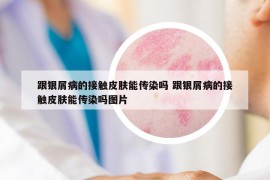 跟银屑病的接触皮肤能传染吗 跟银屑病的接触皮肤能传染吗图片