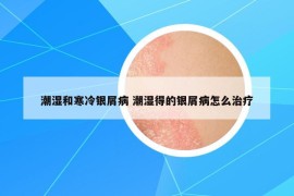 潮湿和寒冷银屑病 潮湿得的银屑病怎么治疗