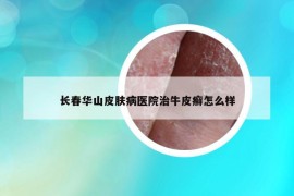 长春华山皮肤病医院治牛皮癣怎么样