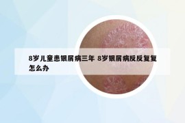 8岁儿童患银屑病三年 8岁银屑病反反复复怎么办