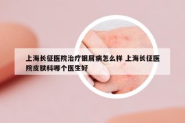 上海长征医院治疗银屑病怎么样 上海长征医院皮肤科哪个医生好