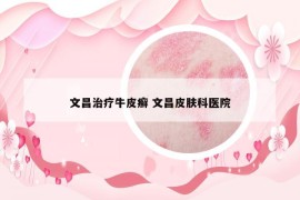 文昌治疗牛皮癣 文昌皮肤科医院