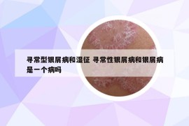 寻常型银屑病和湿征 寻常性银屑病和银屑病是一个病吗