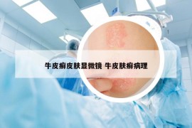 牛皮癣皮肤显微镜 牛皮肤癣病理