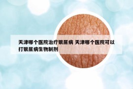 天津哪个医院治疗银屑病 天津哪个医院可以打银屑病生物制剂