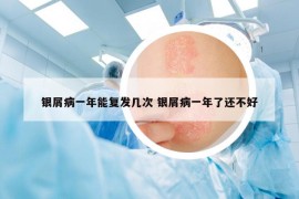 银屑病一年能复发几次 银屑病一年了还不好