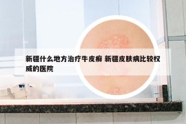 新疆什么地方治疗牛皮癣 新疆皮肤病比较权威的医院