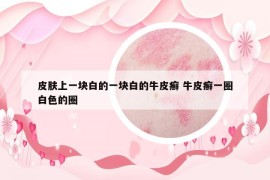 皮肤上一块白的一块白的牛皮癣 牛皮癣一圈白色的圈