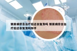 银屑病宗合治疗后还会复发吗 银屑病宗合治疗后还会复发吗知乎