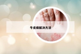 牛皮癣解决方法