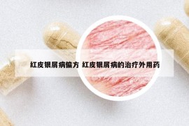 红皮银屑病偏方 红皮银屑病的治疗外用药