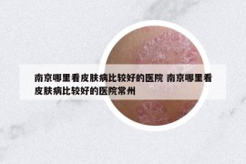 南京哪里看皮肤病比较好的医院 南京哪里看皮肤病比较好的医院常州