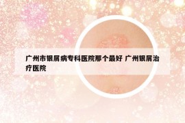 广州市银屑病专科医院那个最好 广州银屑治疗医院