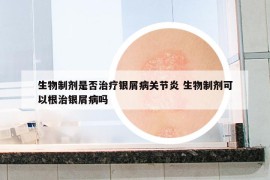 生物制剂是否治疗银屑病关节炎 生物制剂可以根治银屑病吗