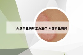 头皮白色鳞屑怎么治疗 头部白色鳞屑